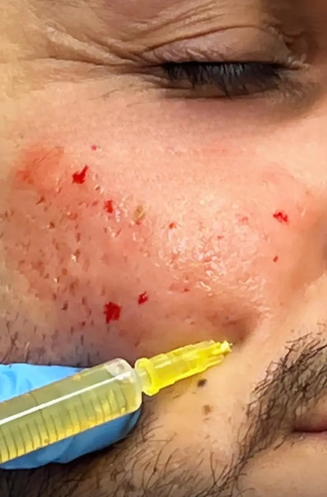 Gallery image - PRP Treatment