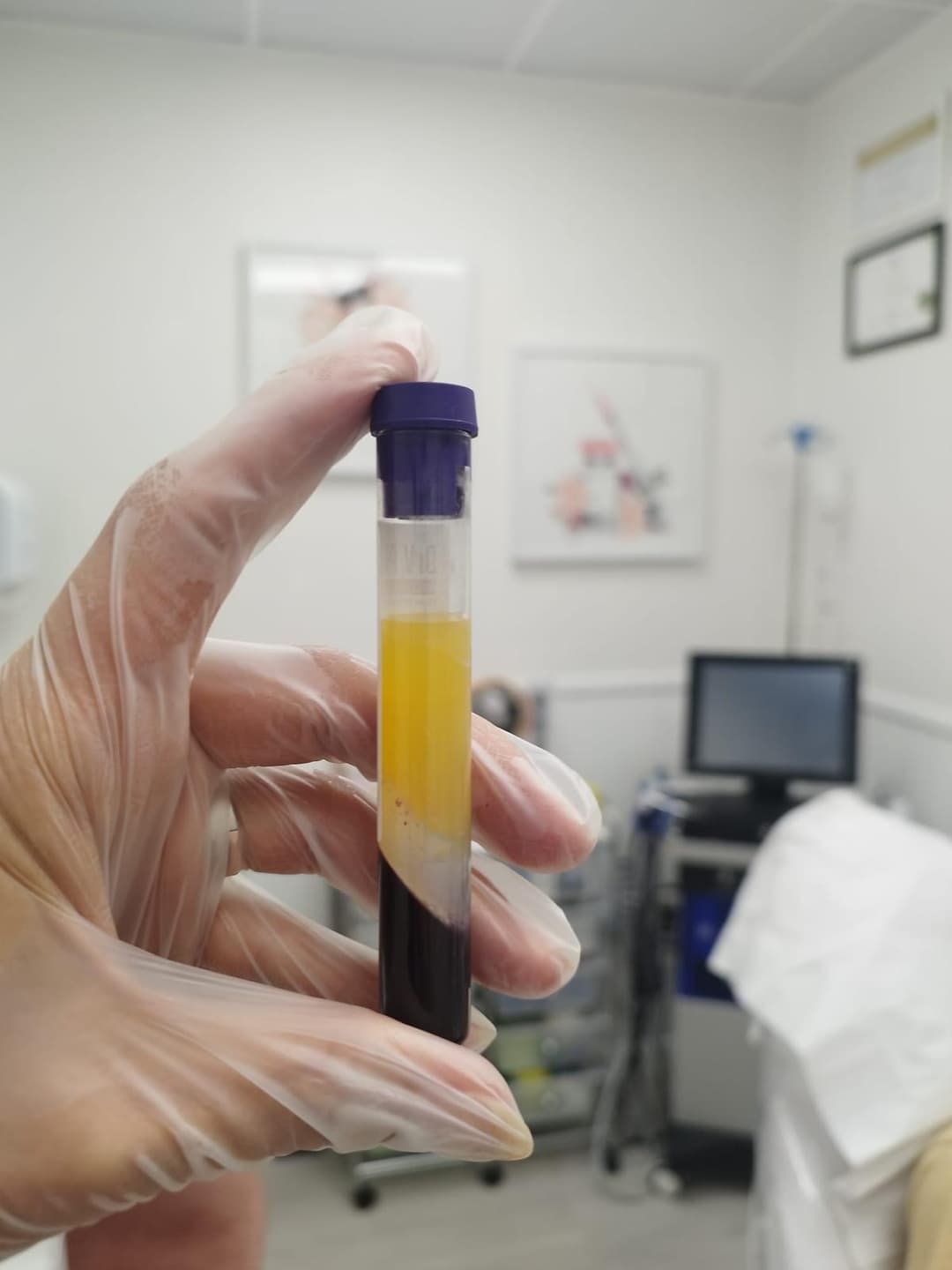 Gallery image - PRP Treatment