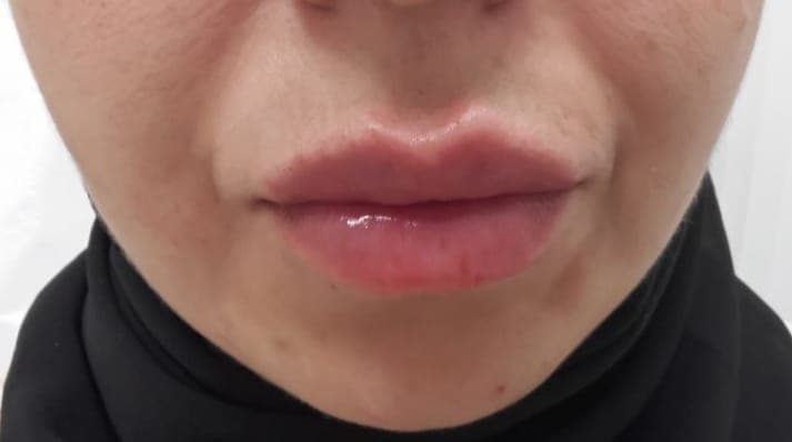 Gallery image - Lip Booster