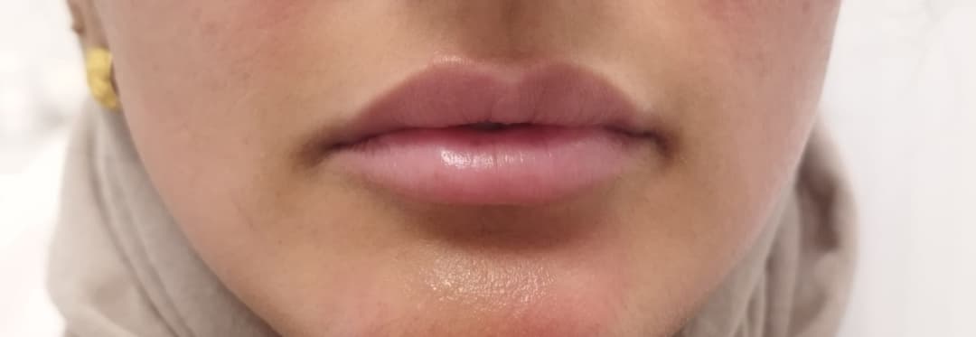 Gallery image - Lip Booster