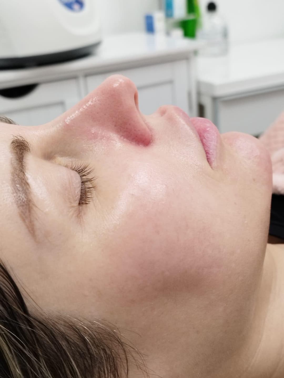 Gallery image - Dermaplaning