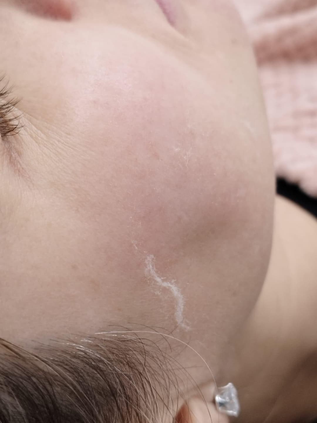Gallery image - Dermaplaning