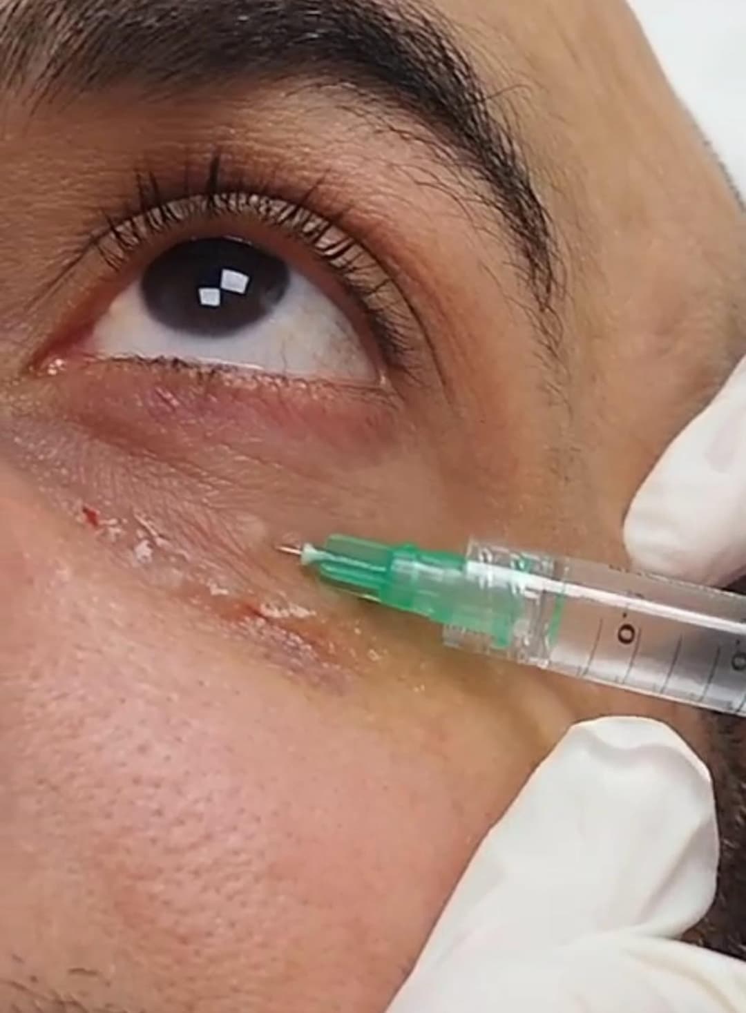 Gallery image - Eye Dark Circles